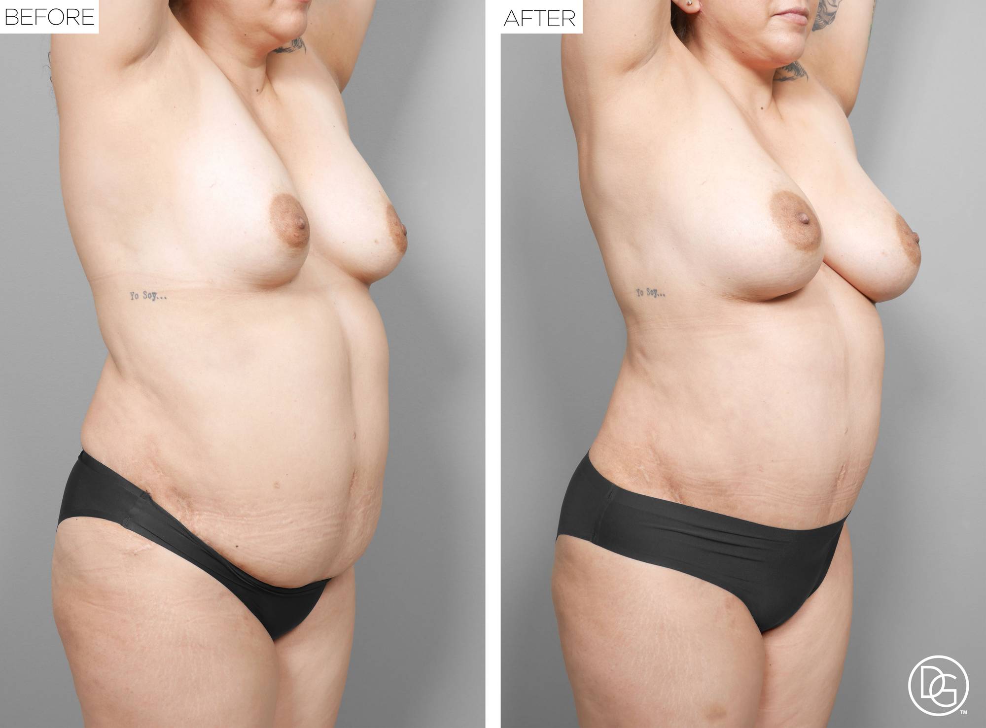 Liposuction Before & After Image
