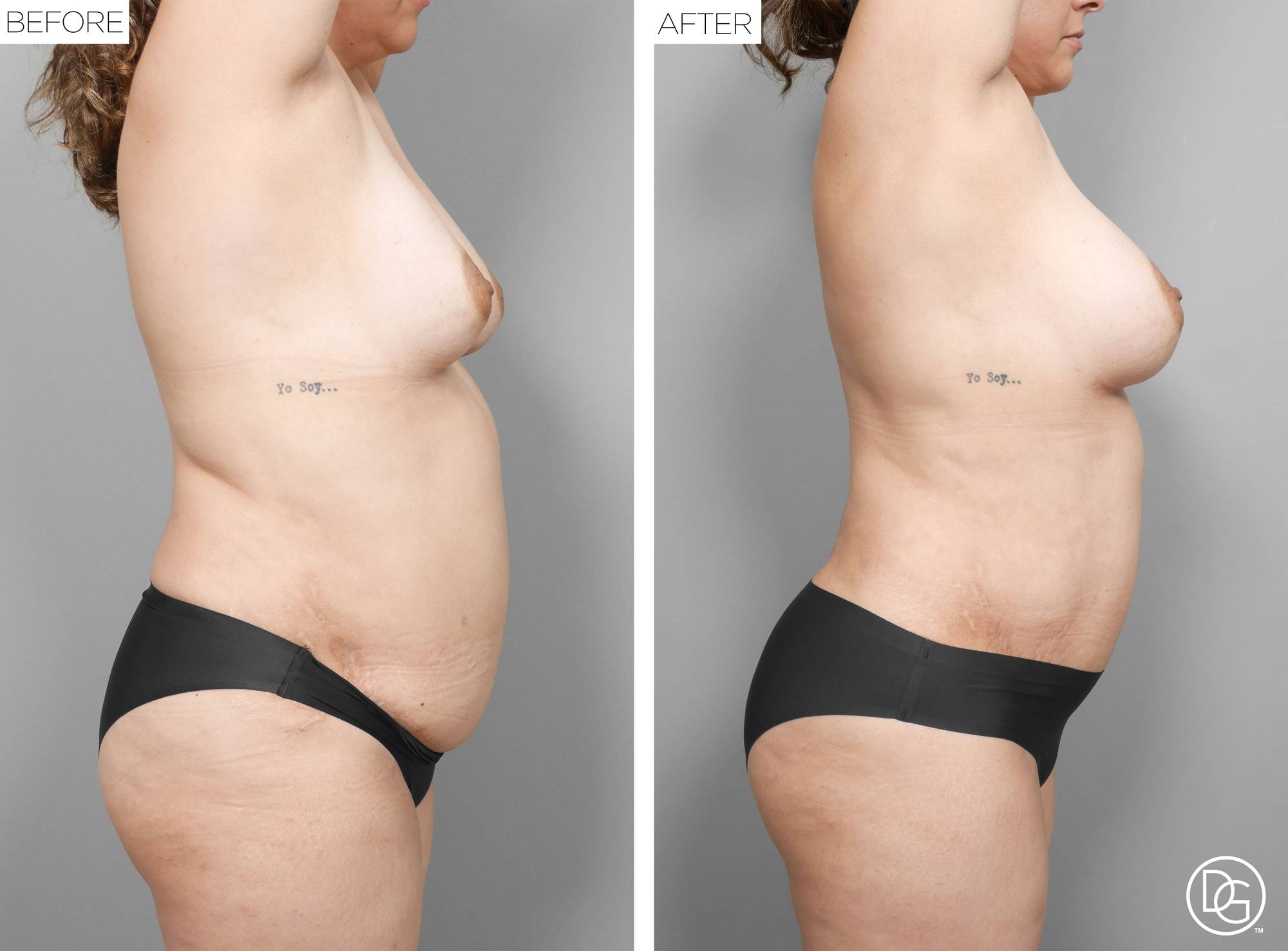 Liposuction Before & After Image