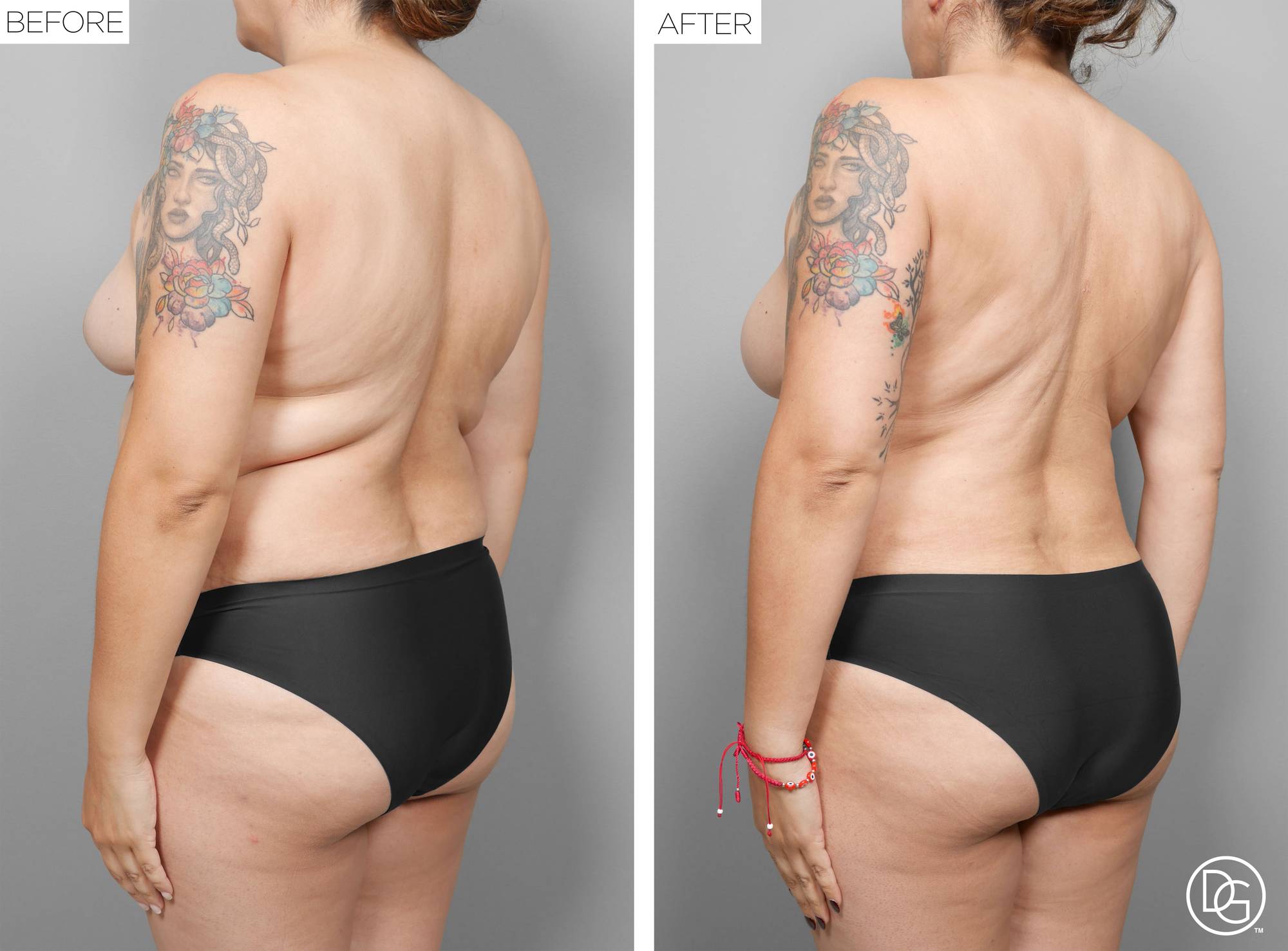 Liposuction Before & After Image