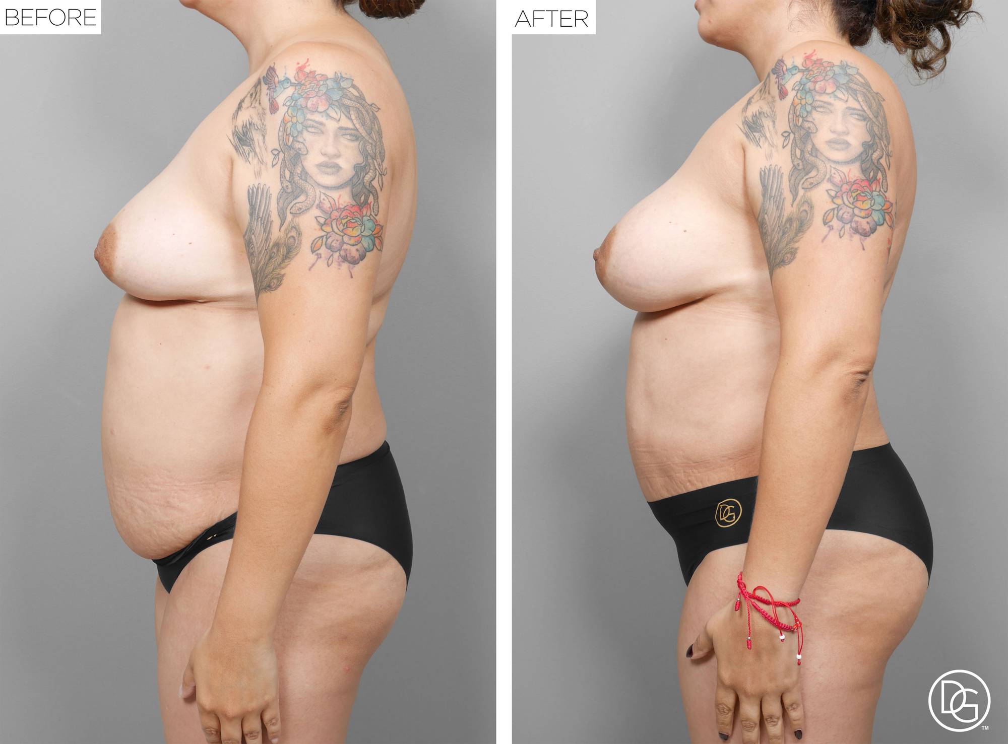 Liposuction Before & After Image