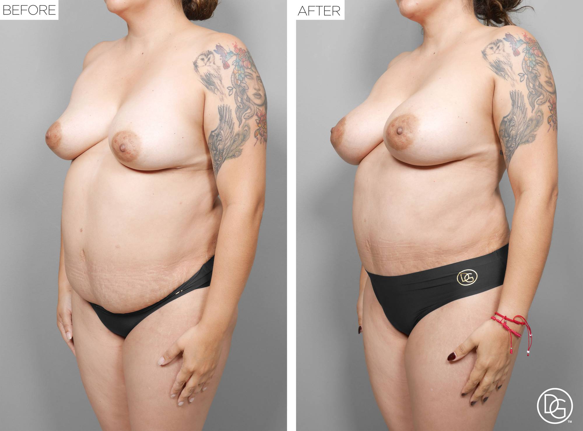 Liposuction Before & After Image
