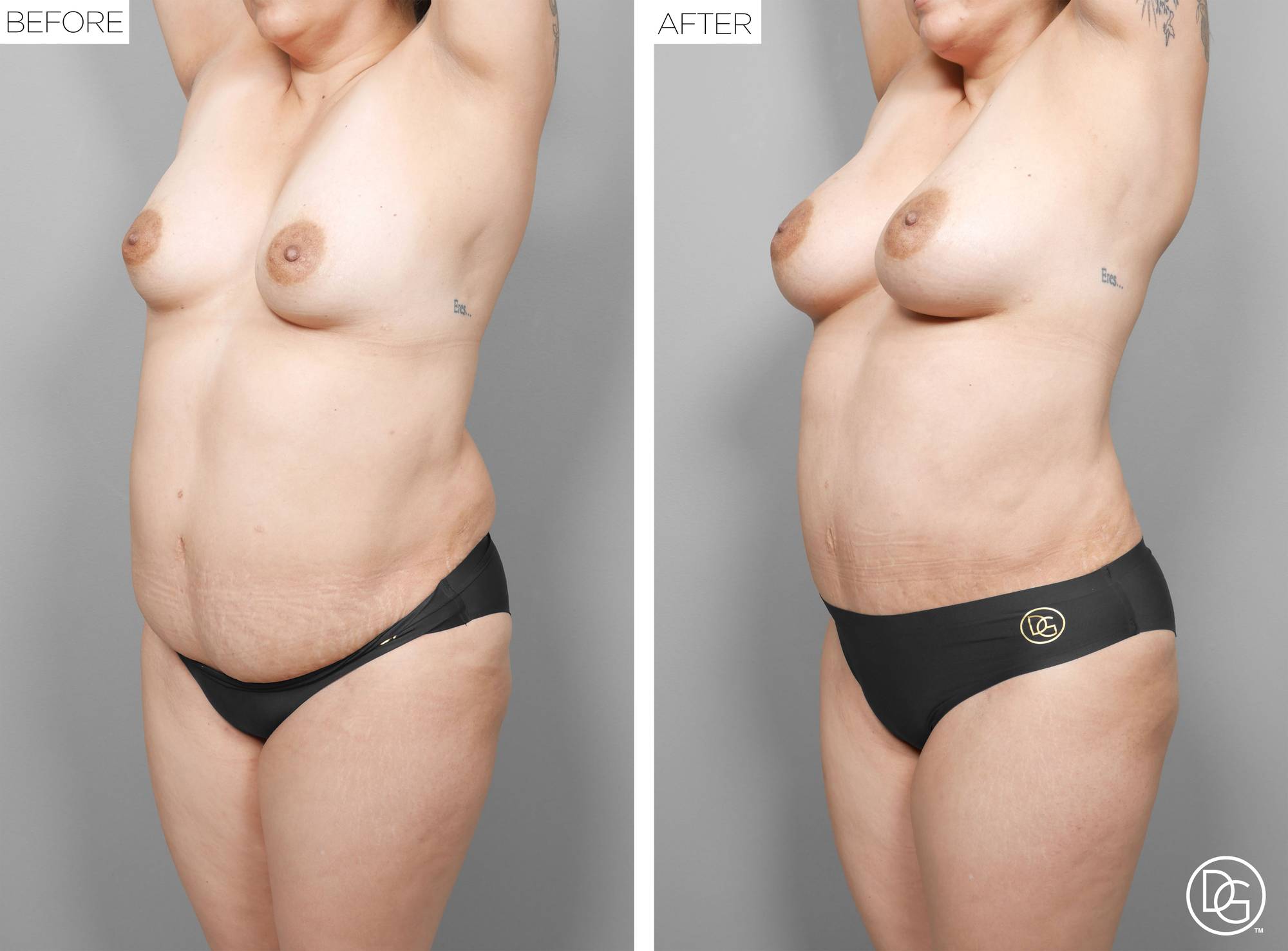 Liposuction Before & After Image