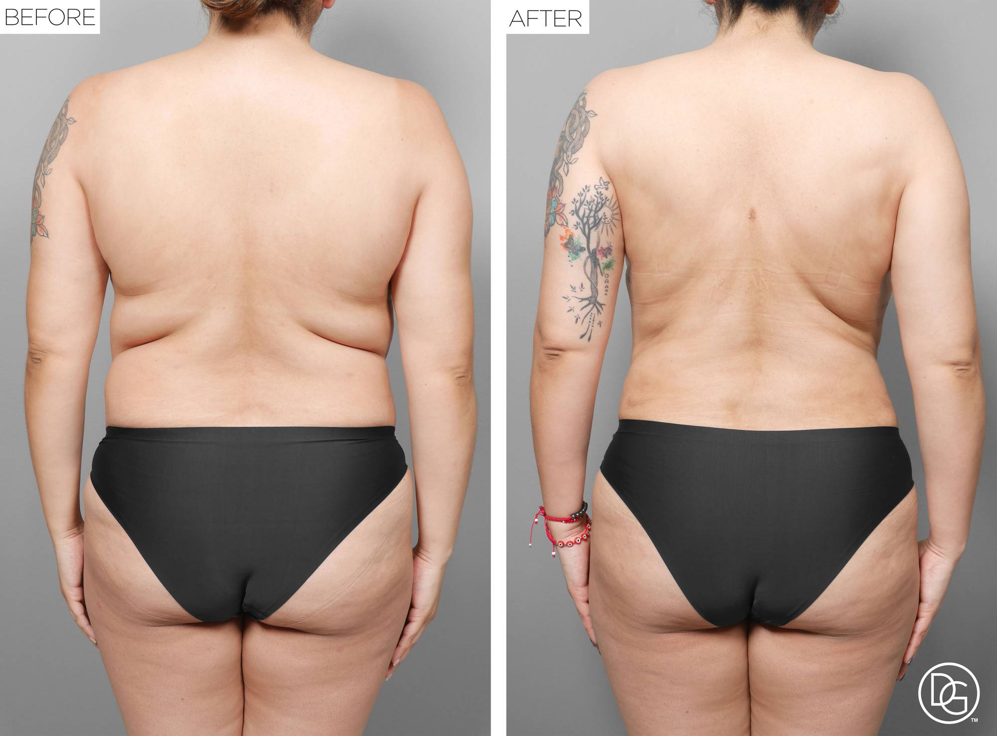 Liposuction Before & After Image