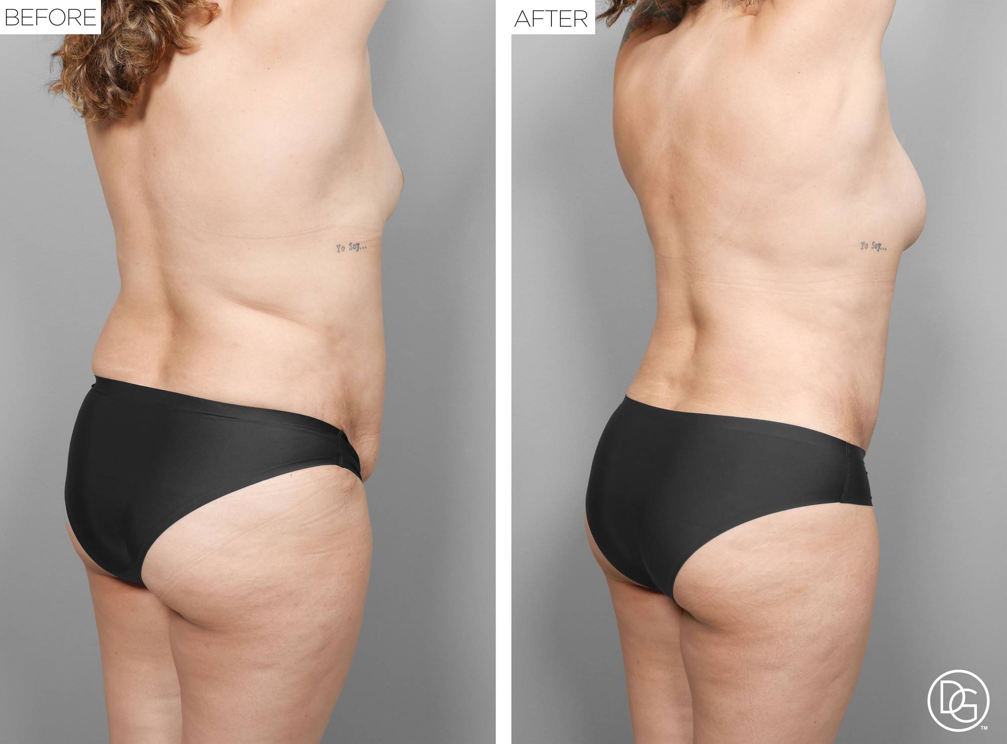 Liposuction Before & After Image
