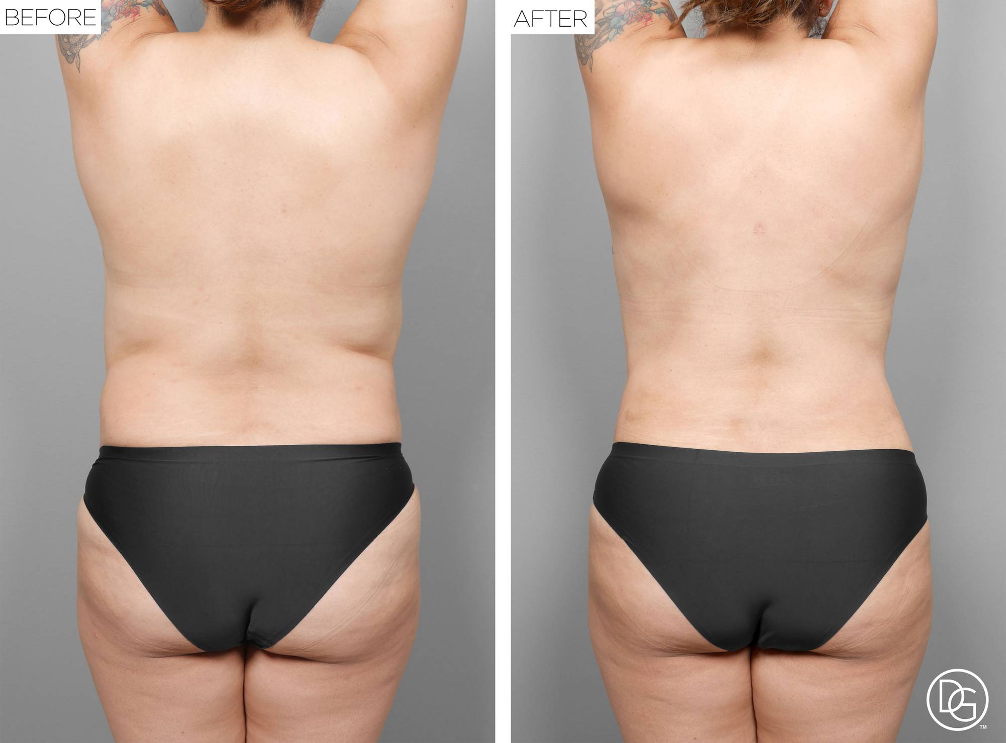 Liposuction Before & After Image