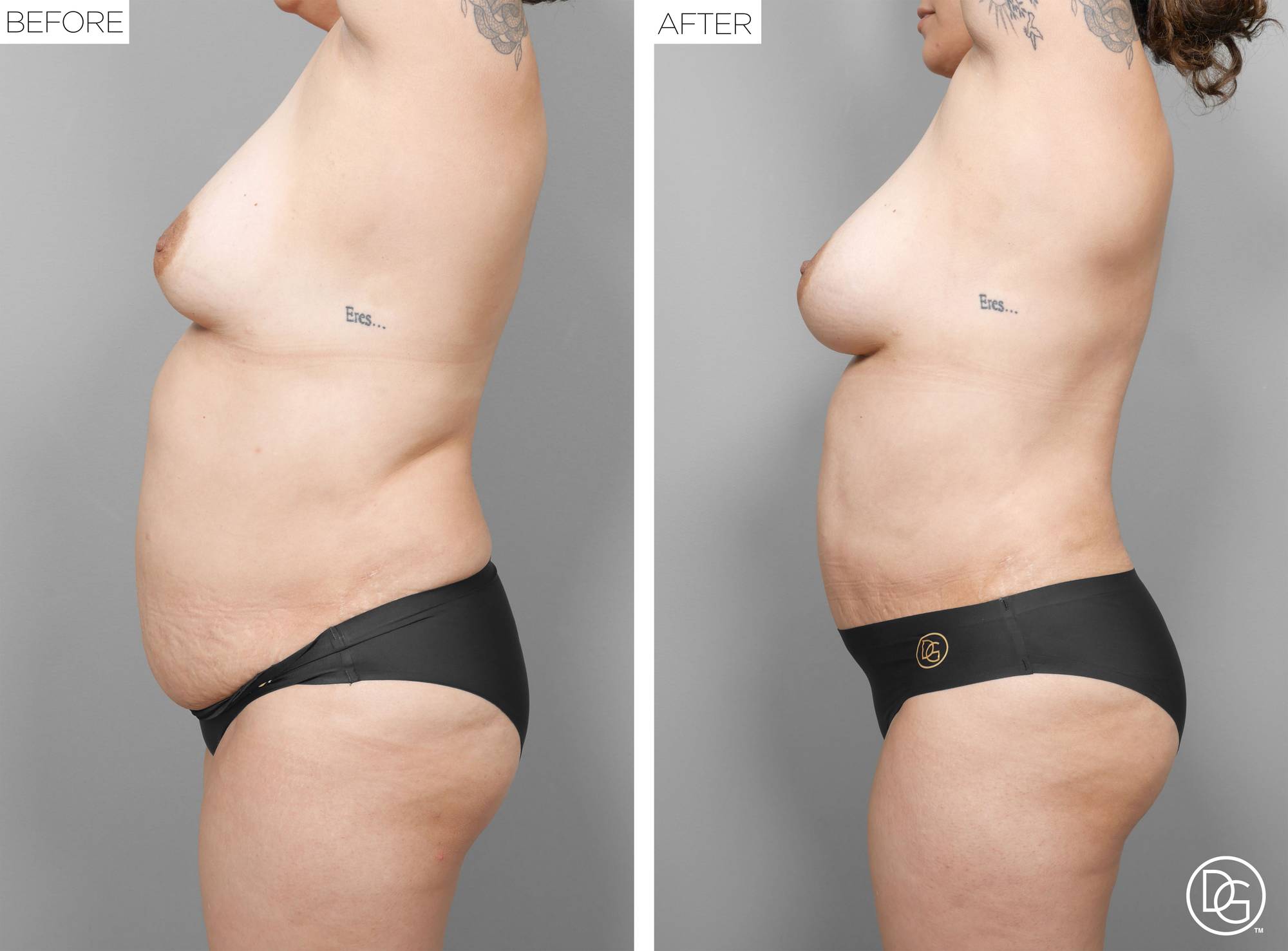 Liposuction Before & After Image