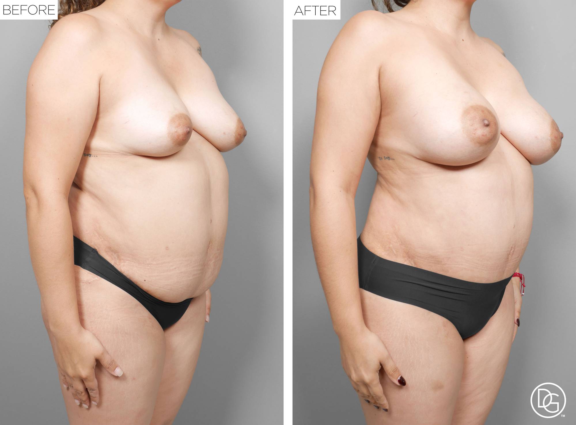 Liposuction Before & After Image