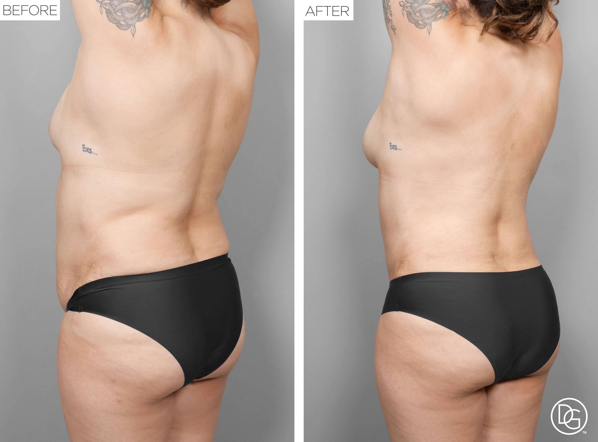 Liposuction Before & After Image