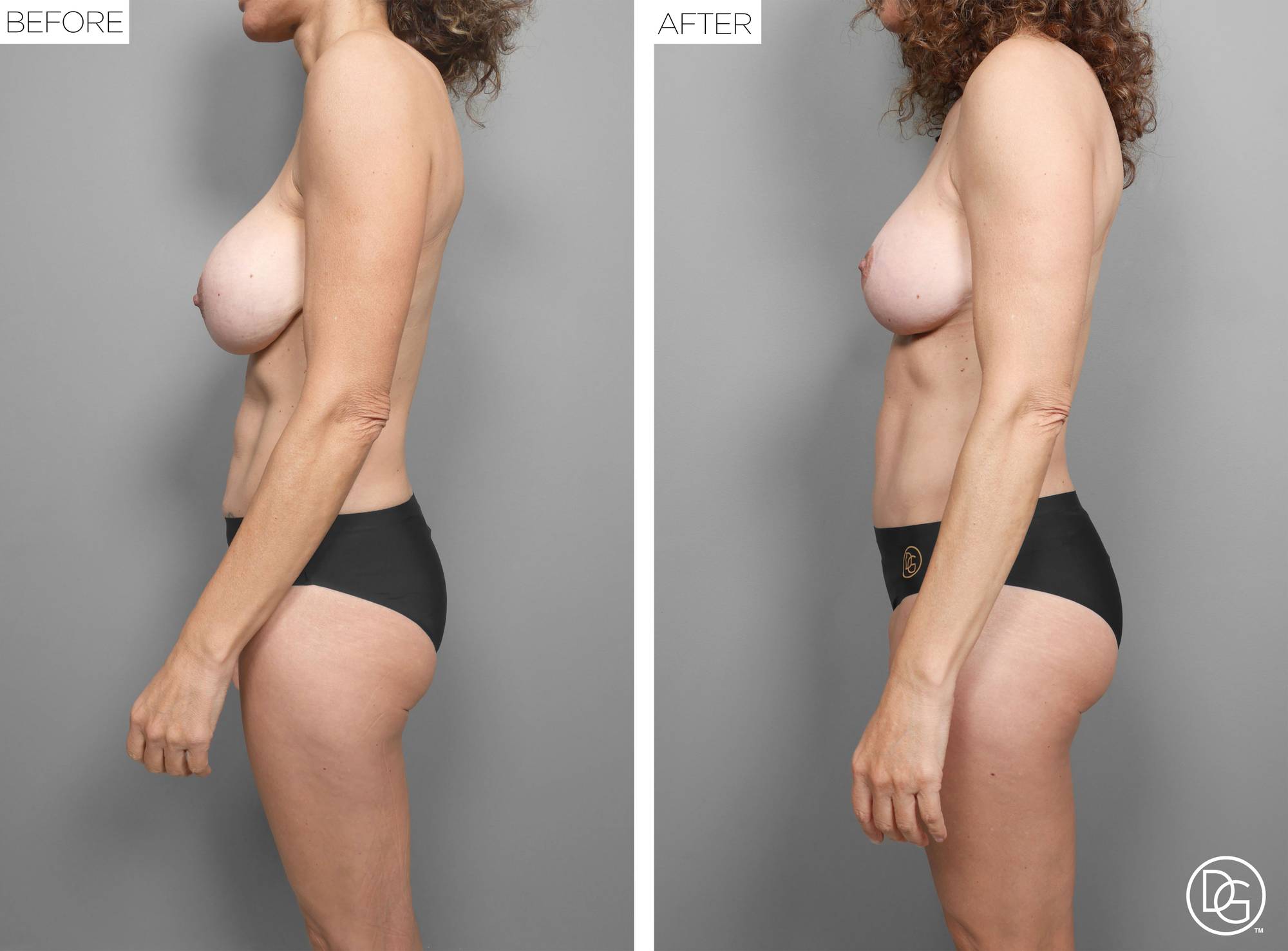 Mommy Makeover Before & After Image