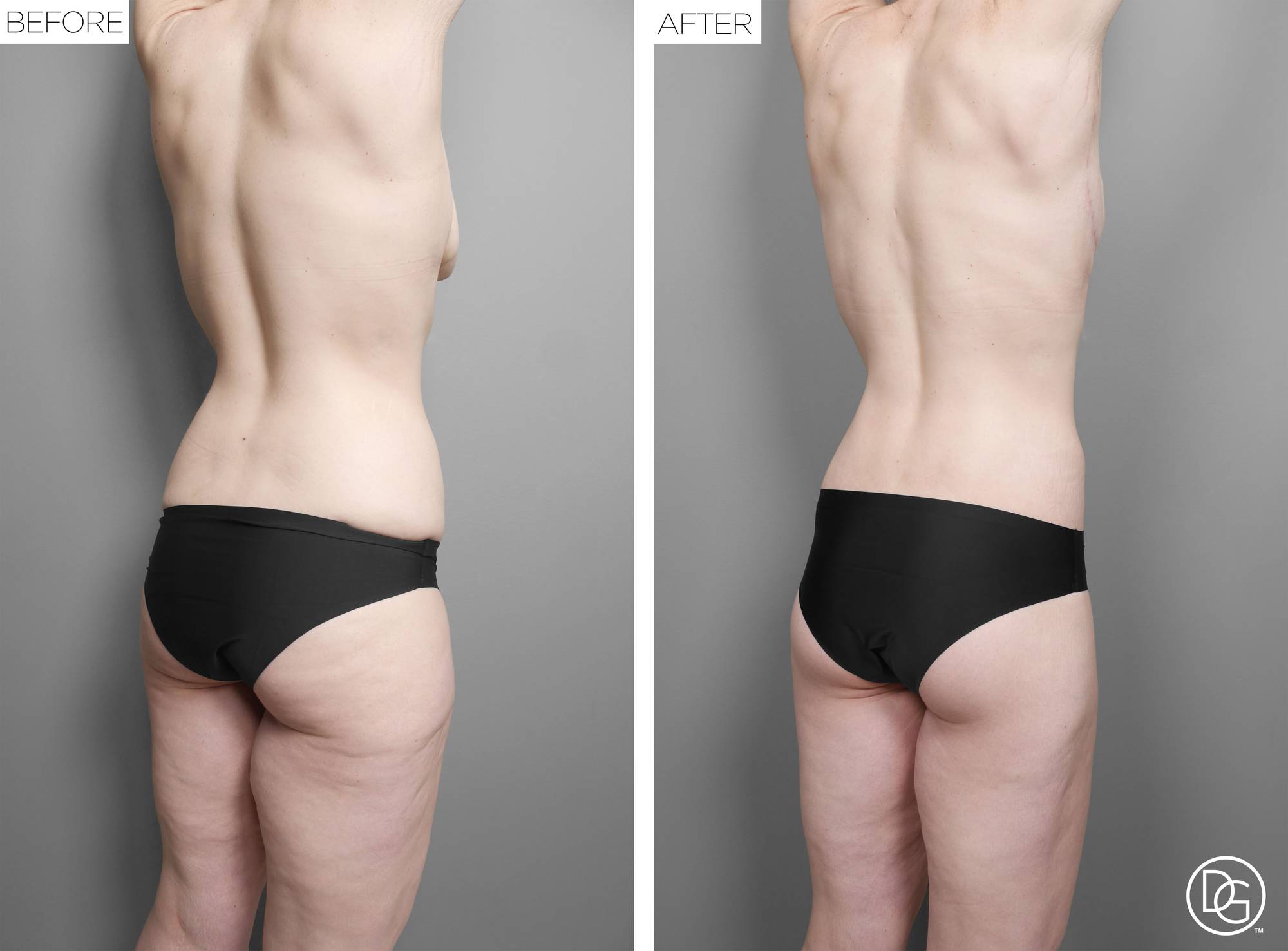 Back Lift Before & After Image