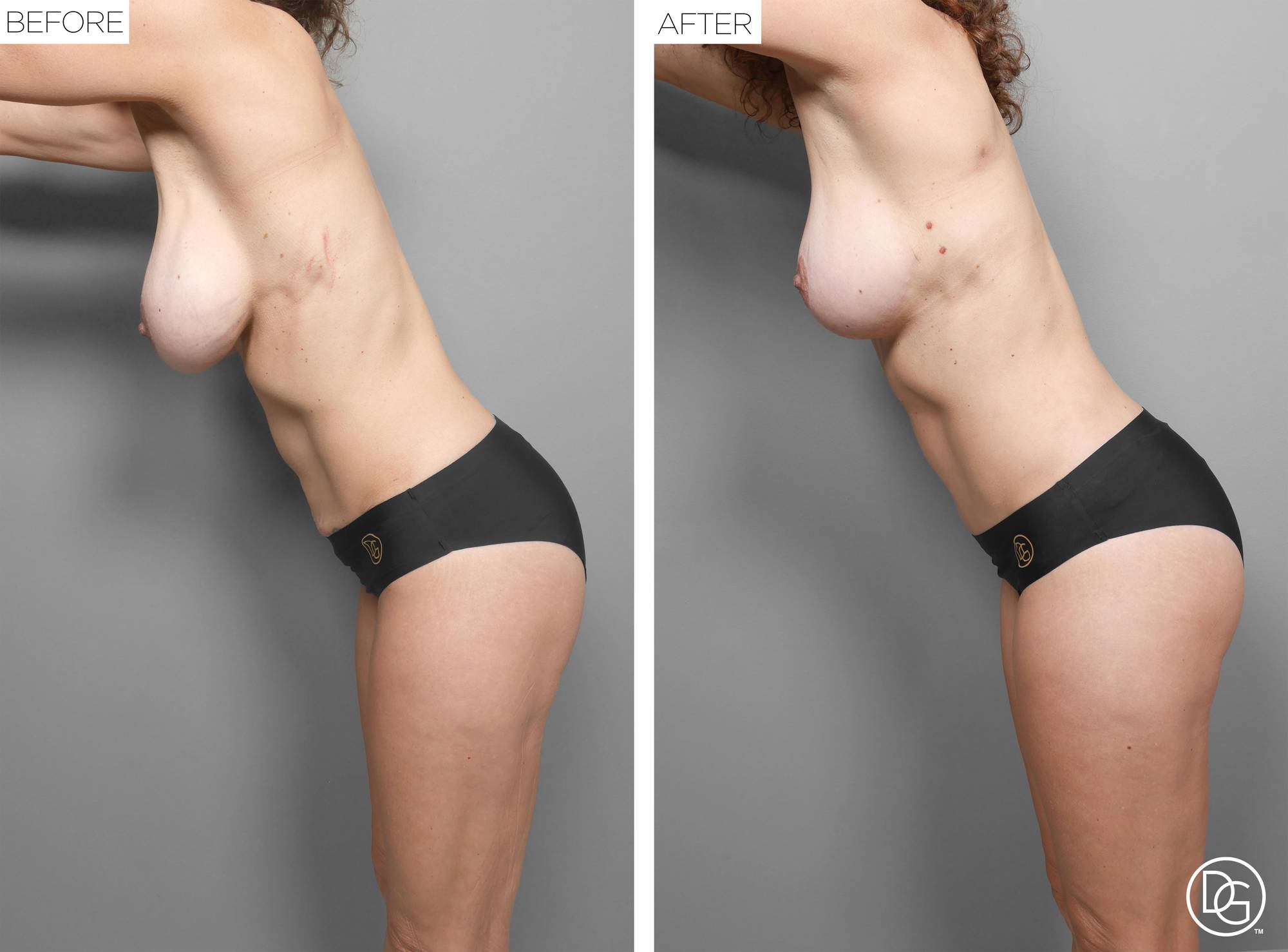 Mommy Makeover Before & After Image