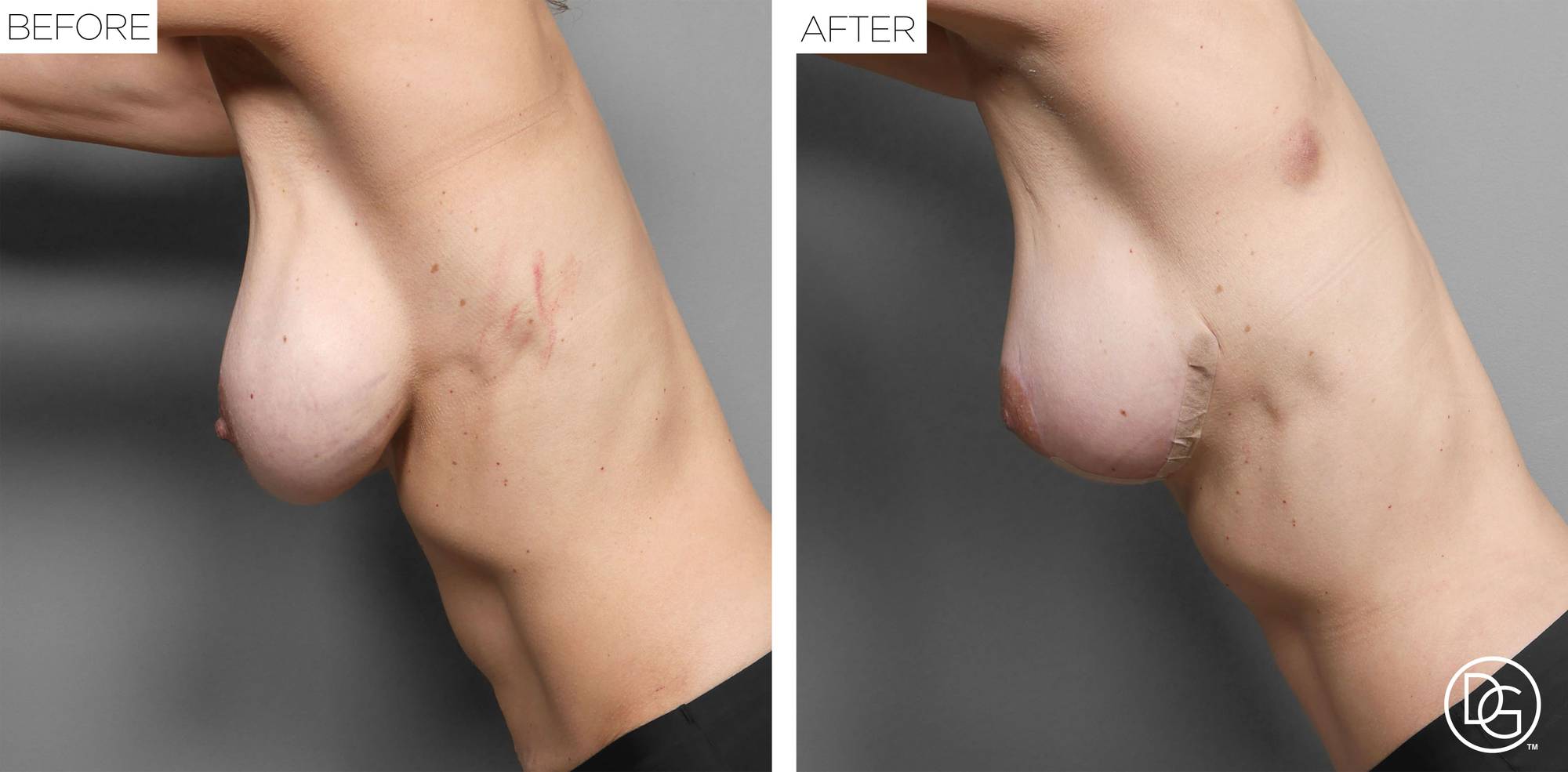 Breast Lift Before & After Image