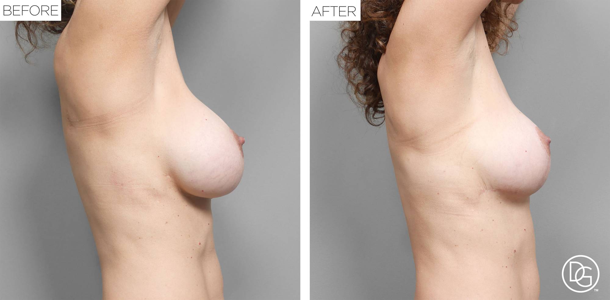 Breast Lift Before & After Image