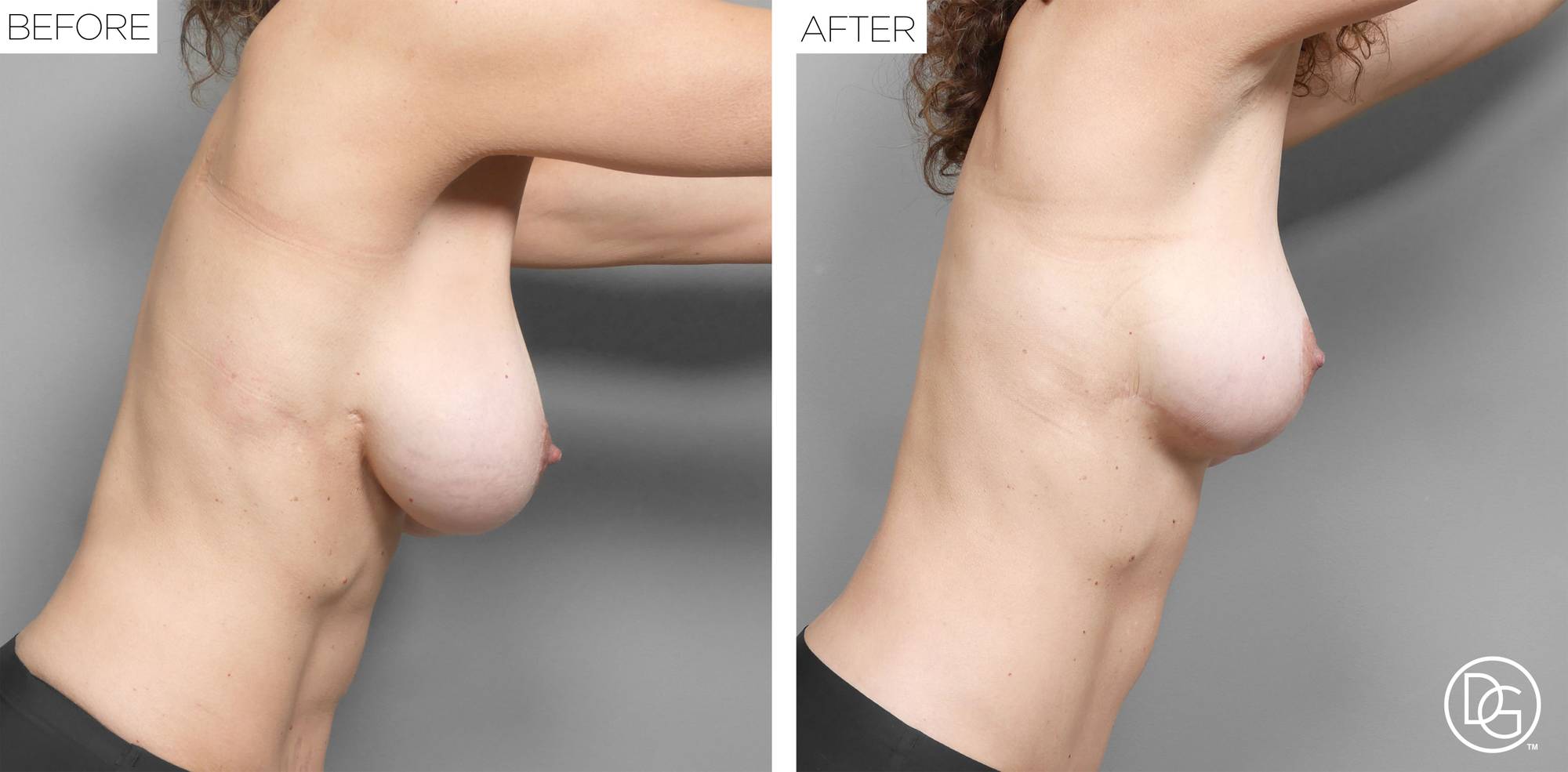 Breast Lift Before & After Image