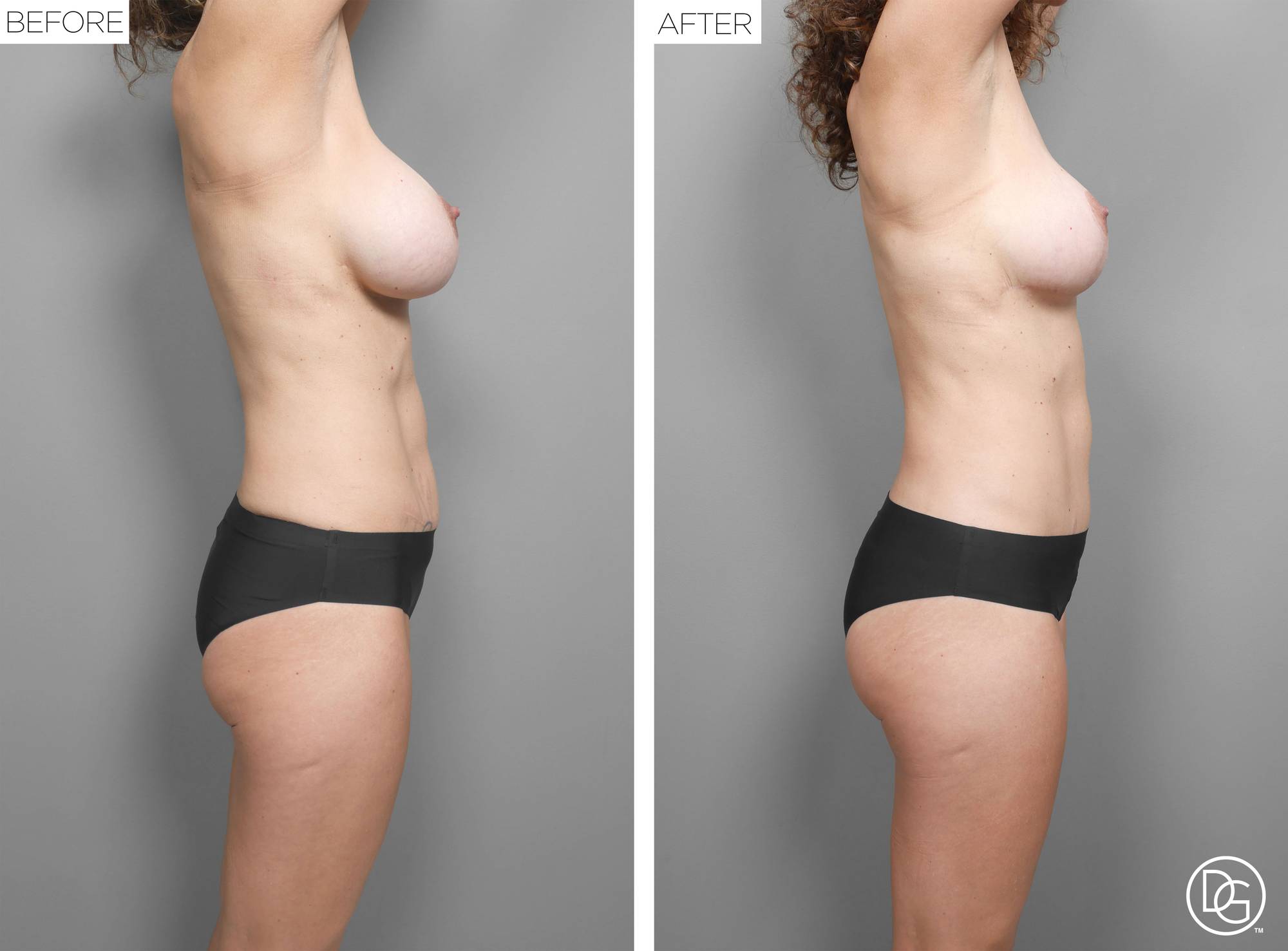 Mommy Makeover Before & After Image