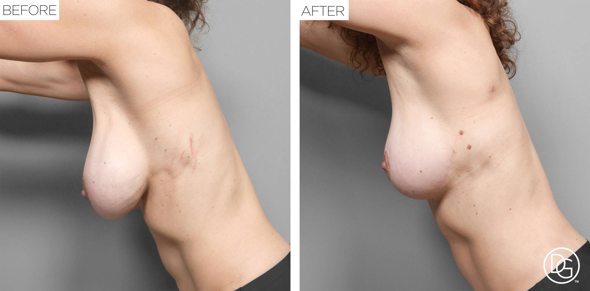 Breast Lift Before & After Image