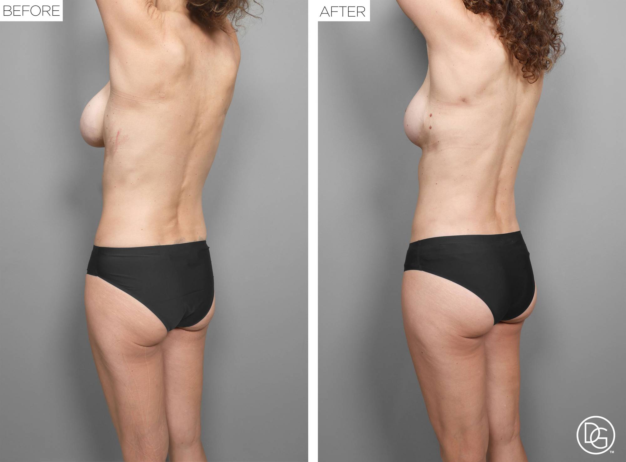 Back Lift Before & After Image