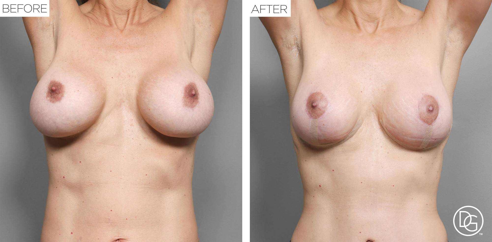 Breast Lift Before & After Image