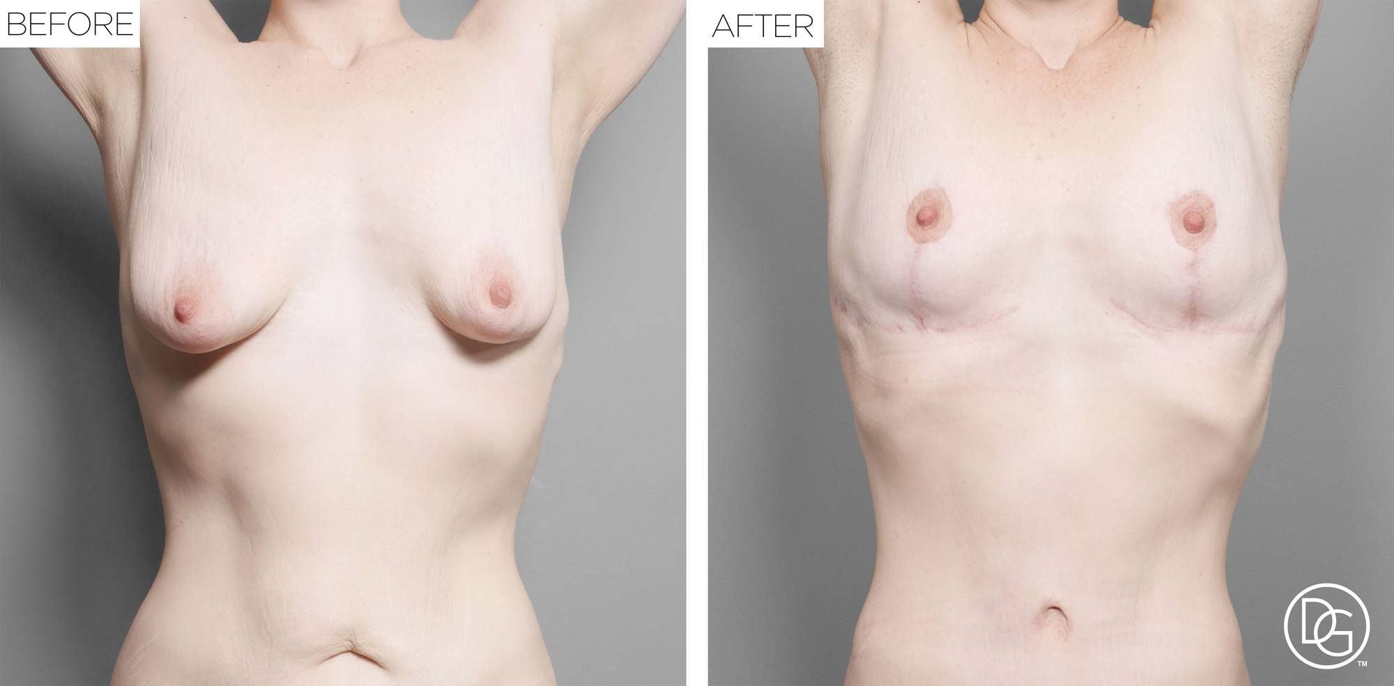 Breast Lift Before & After Image