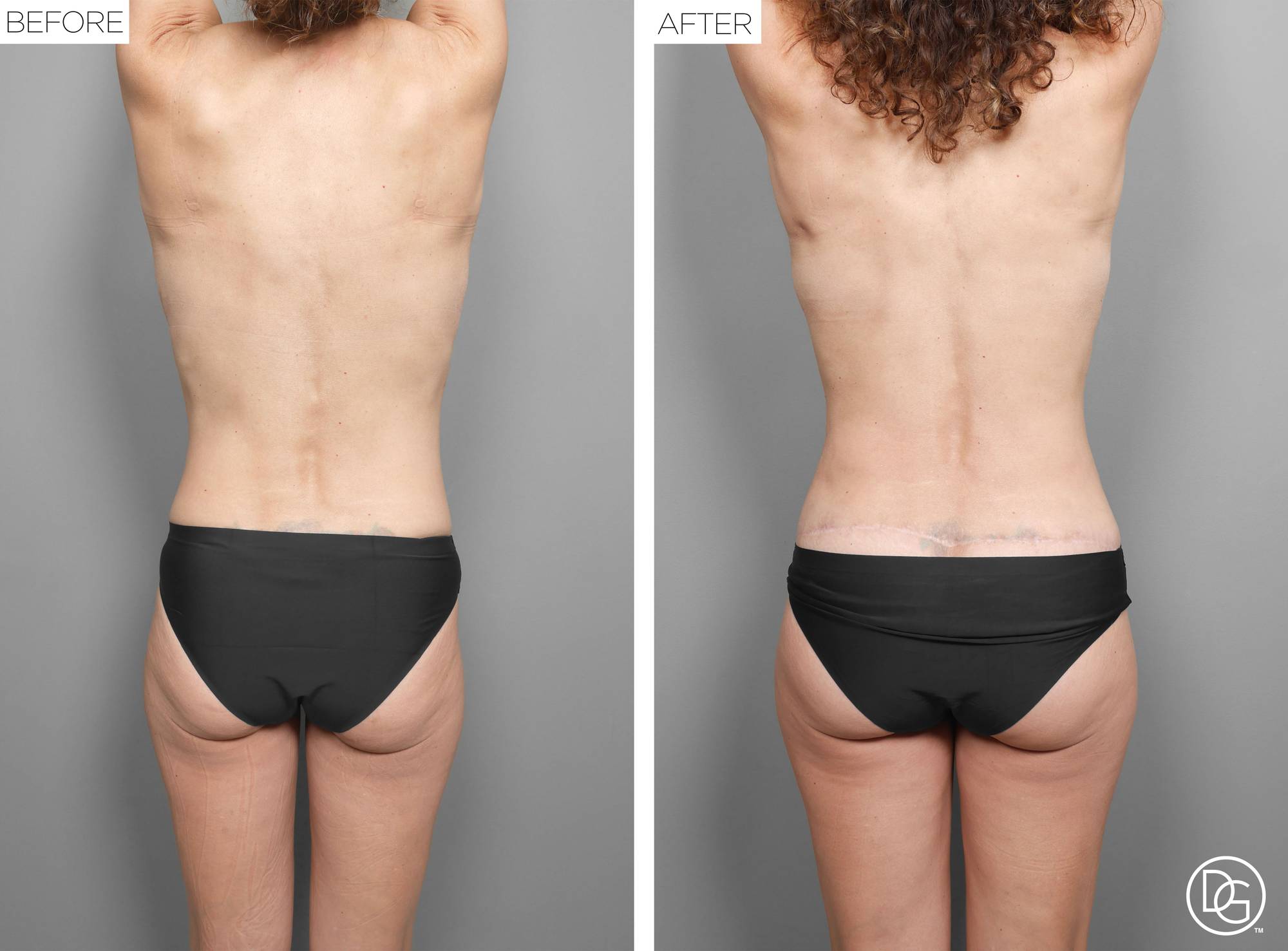 Back Lift Before & After Image