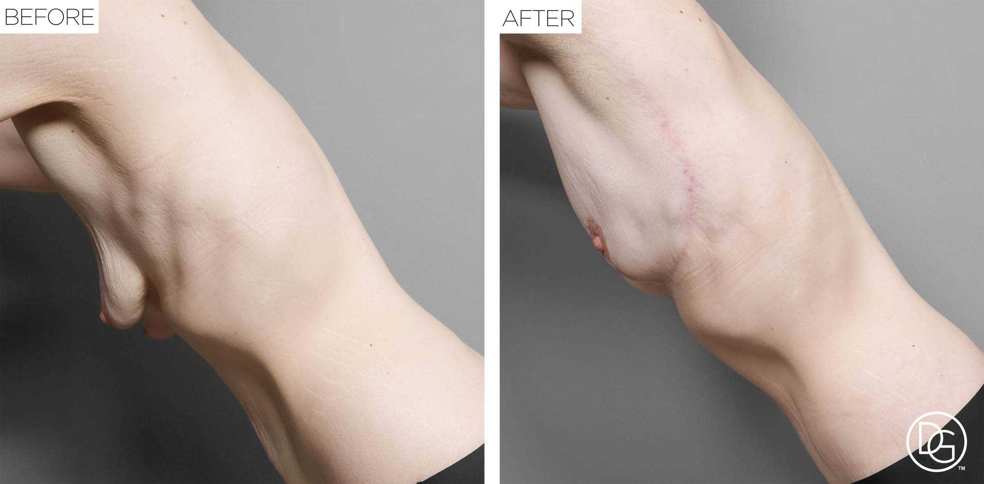 Breast Lift Before & After Image