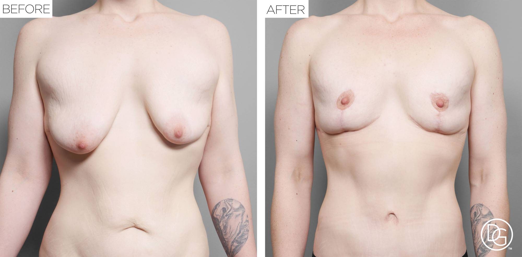 Breast Lift Before & After Image