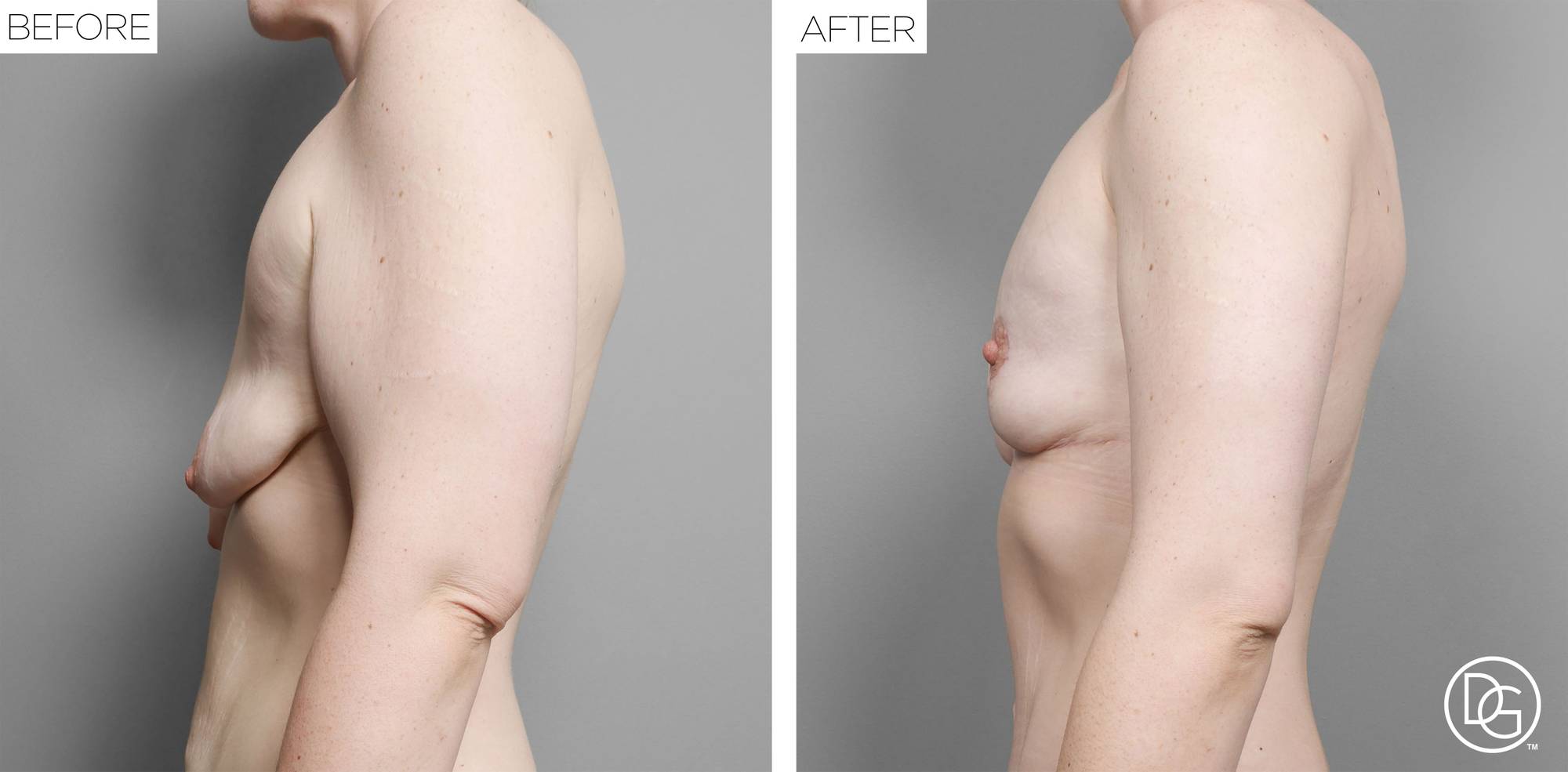 Breast Lift Before & After Image