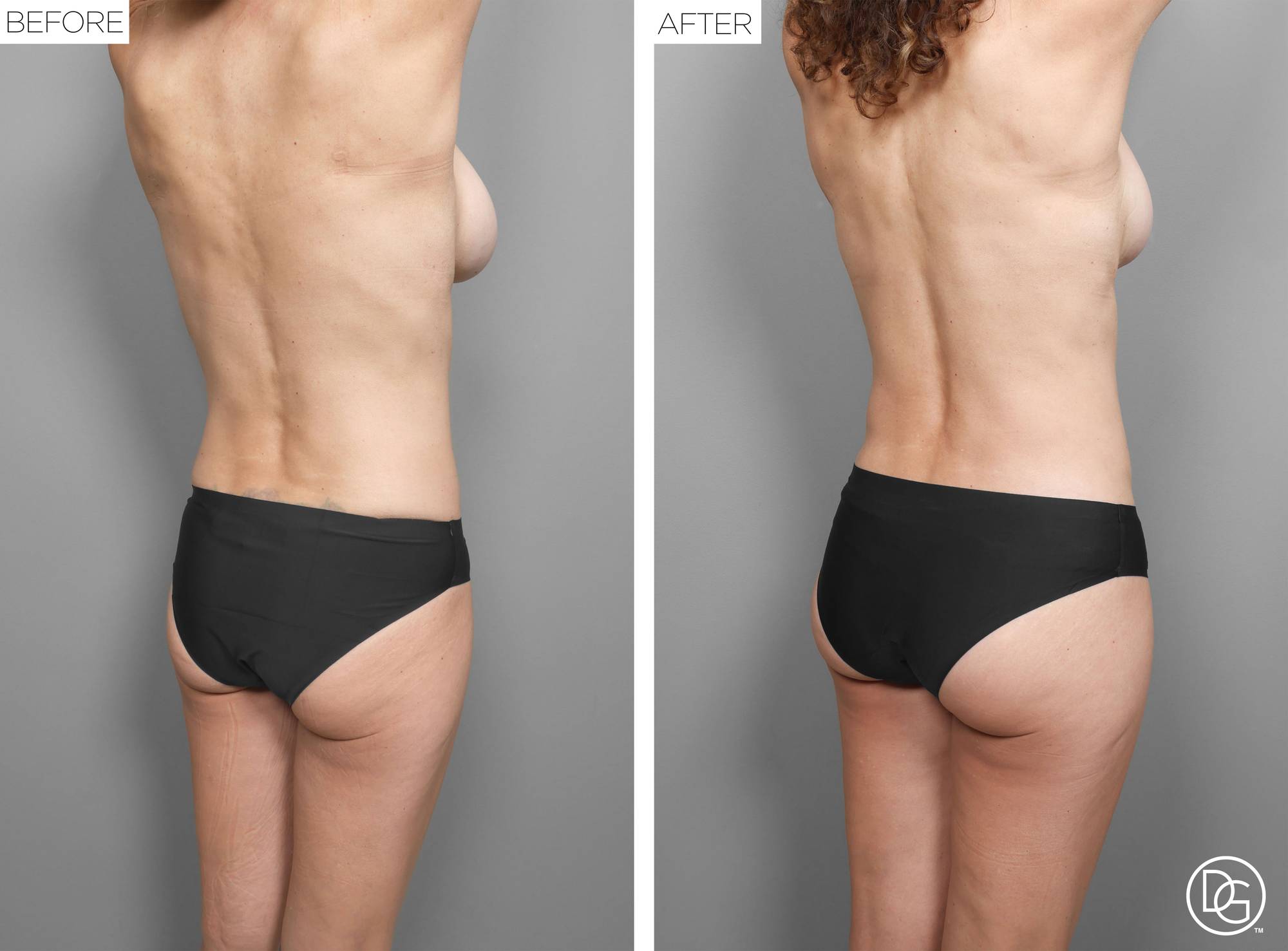 Back Lift Before & After Image