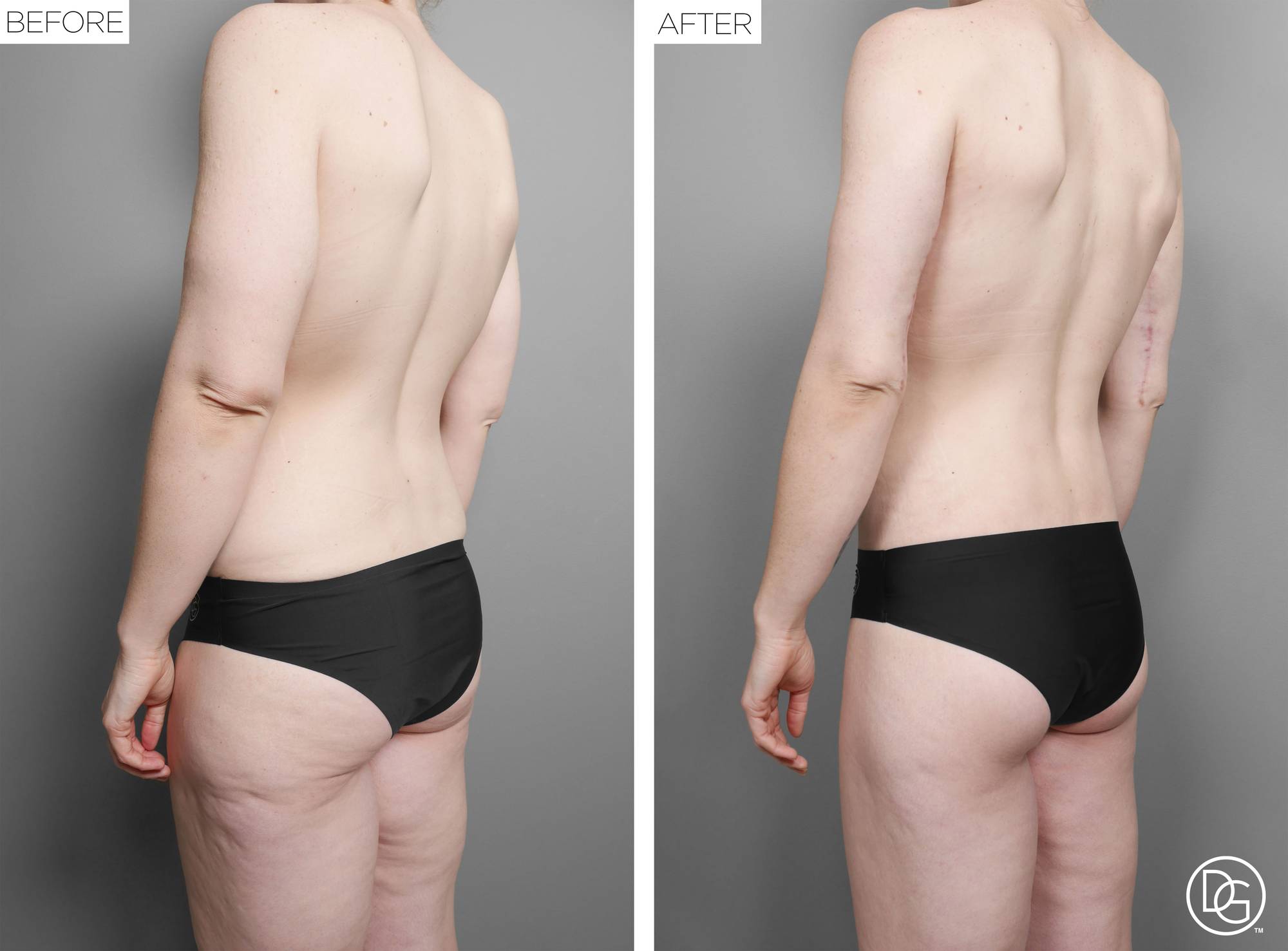 Back Lift Before & After Image