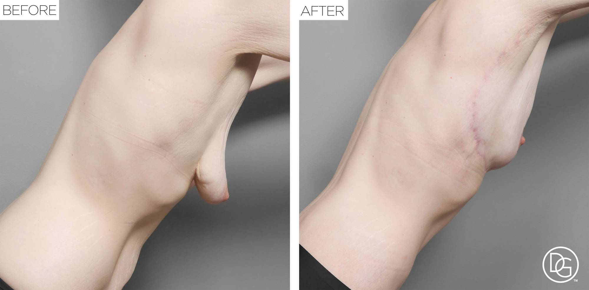 Breast Lift Before & After Image