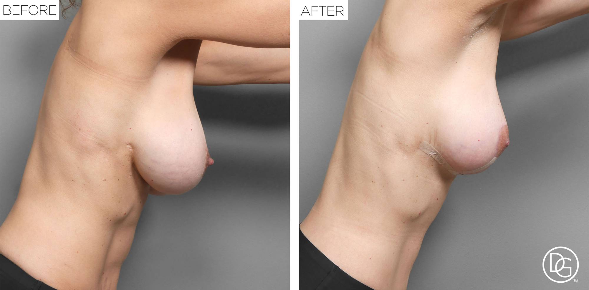 Breast Lift Before & After Image