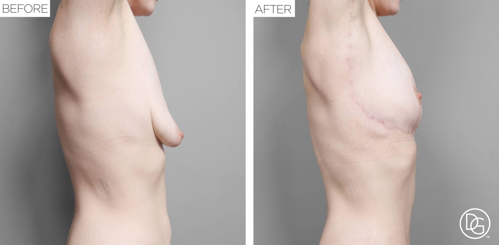 Breast Lift Before & After Image