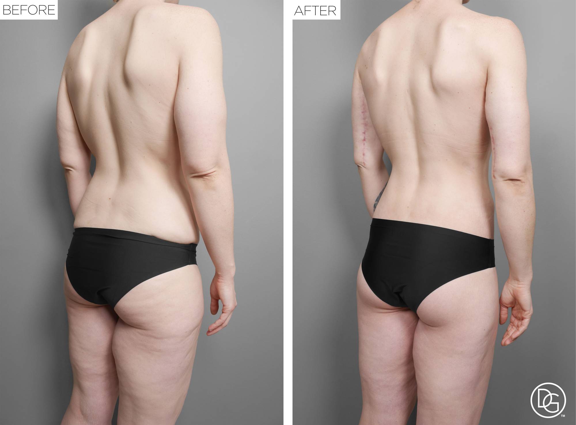 Back Lift Before & After Image