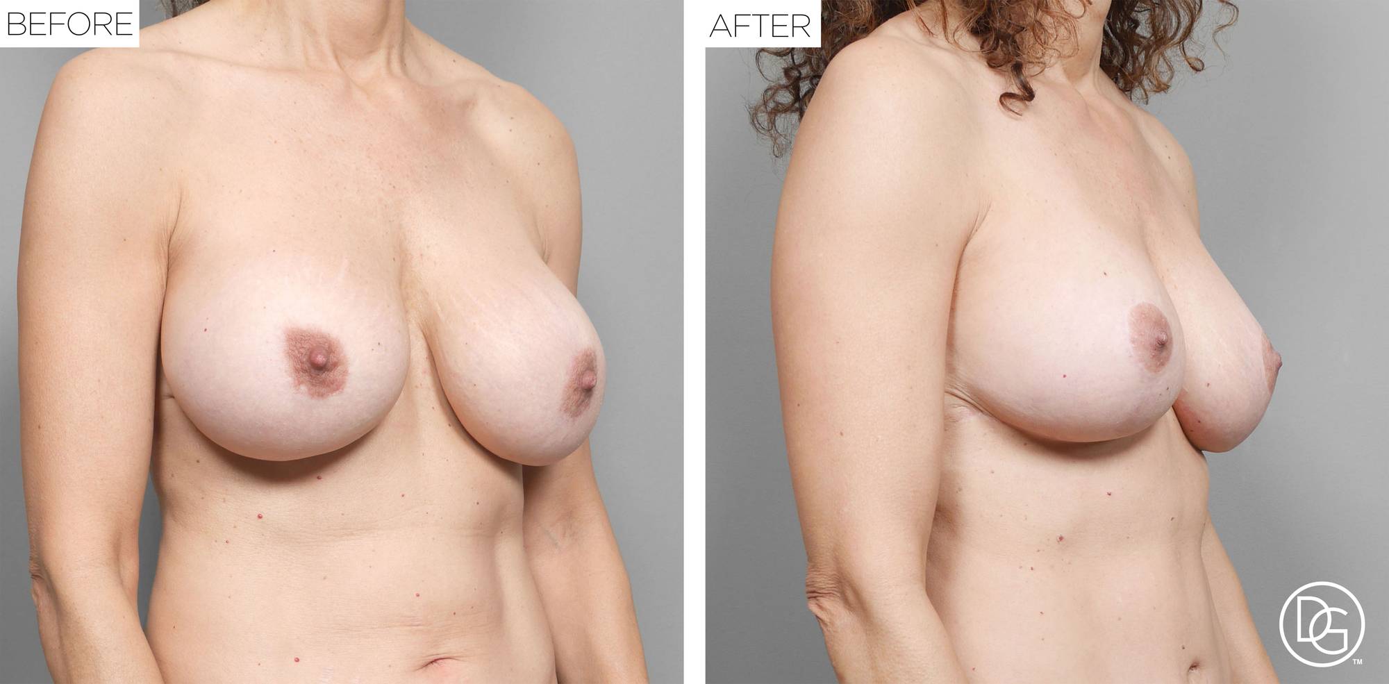 Breast Lift Before & After Image