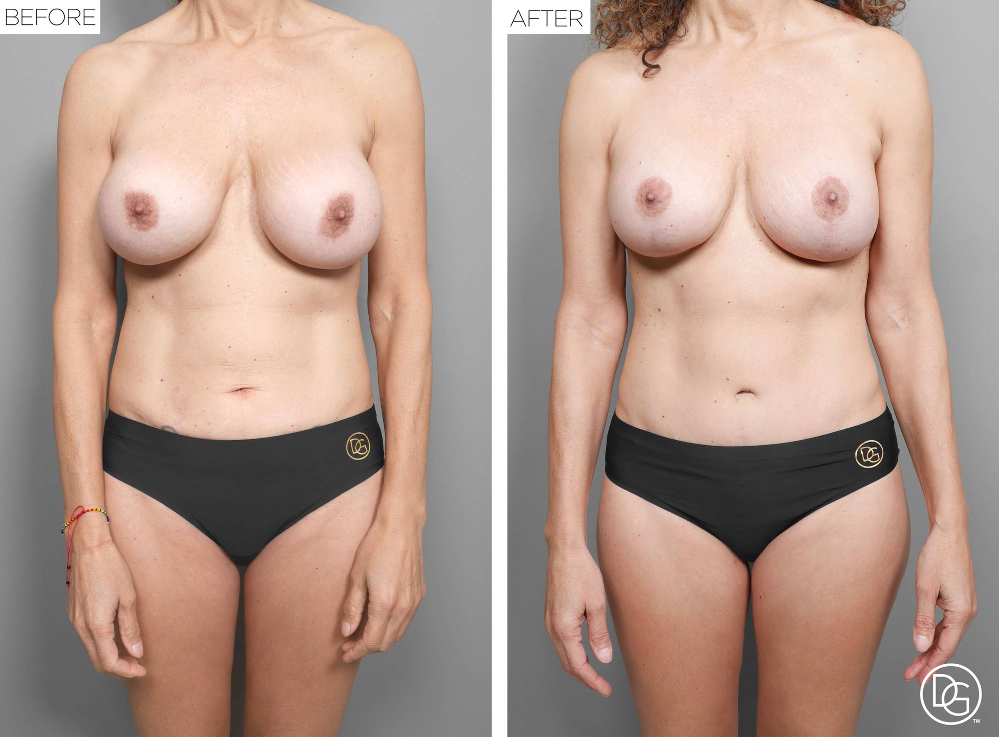 Mommy Makeover Before & After Image