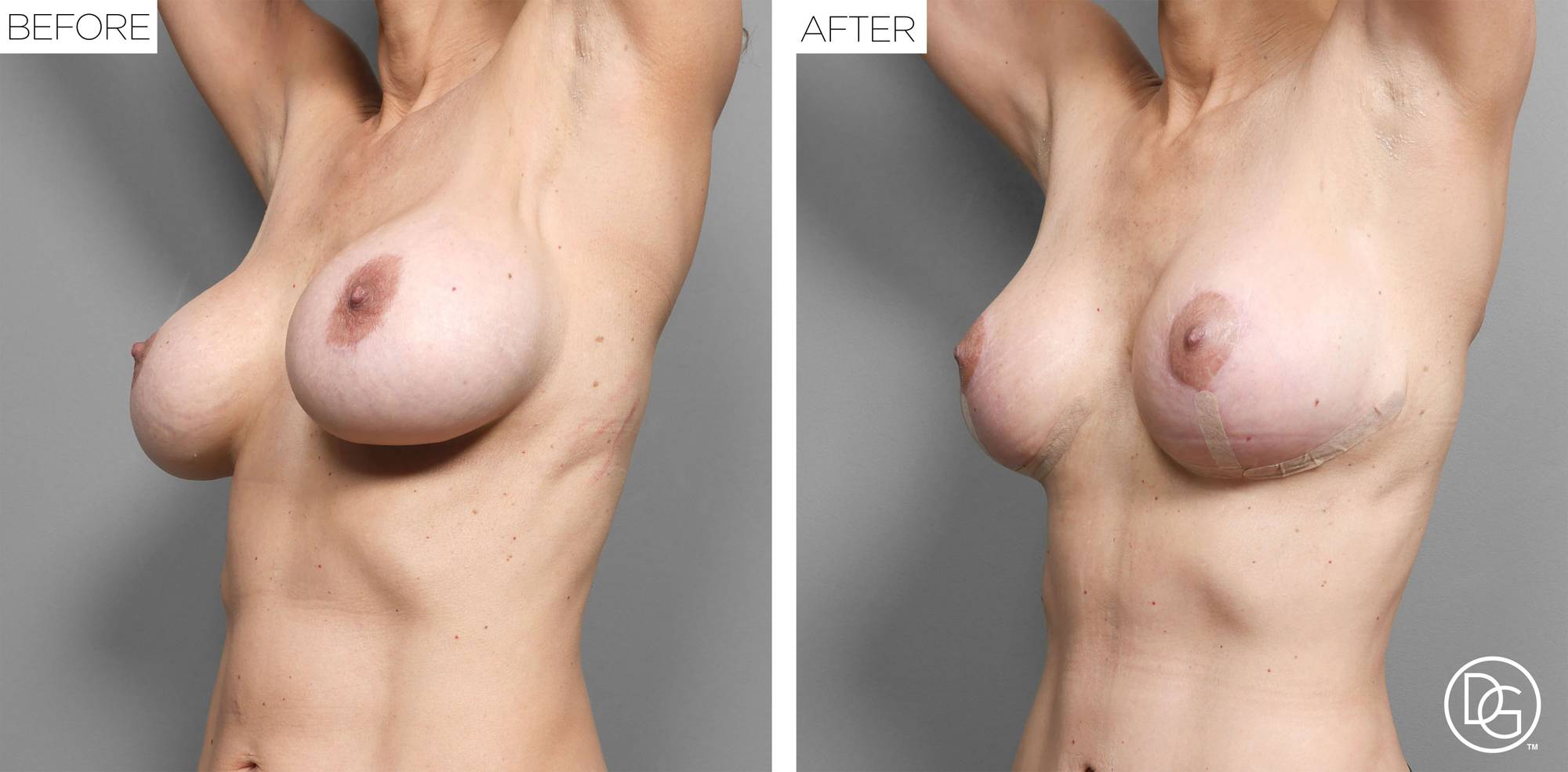 Breast Lift Before & After Image