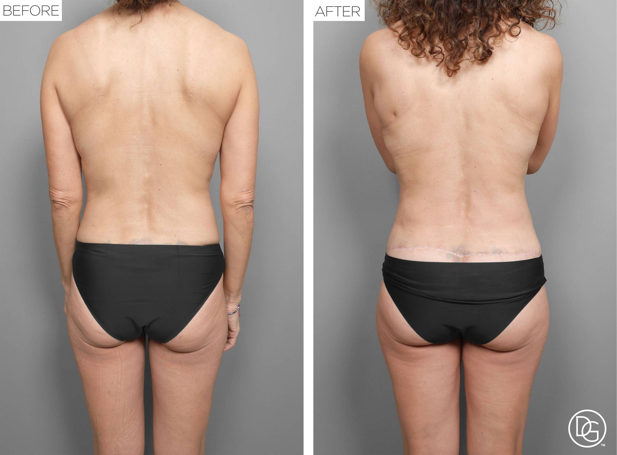 Mommy Makeover Before & After Image