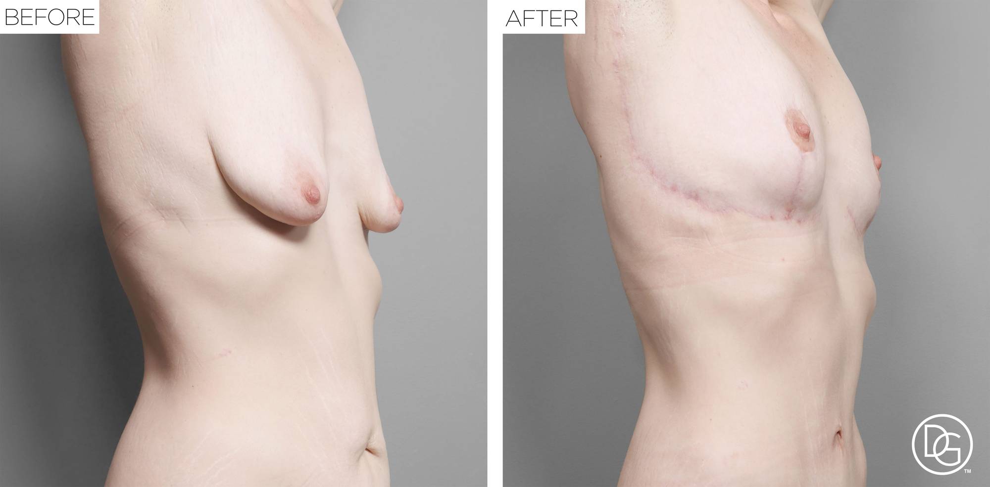 Breast Lift Before & After Image