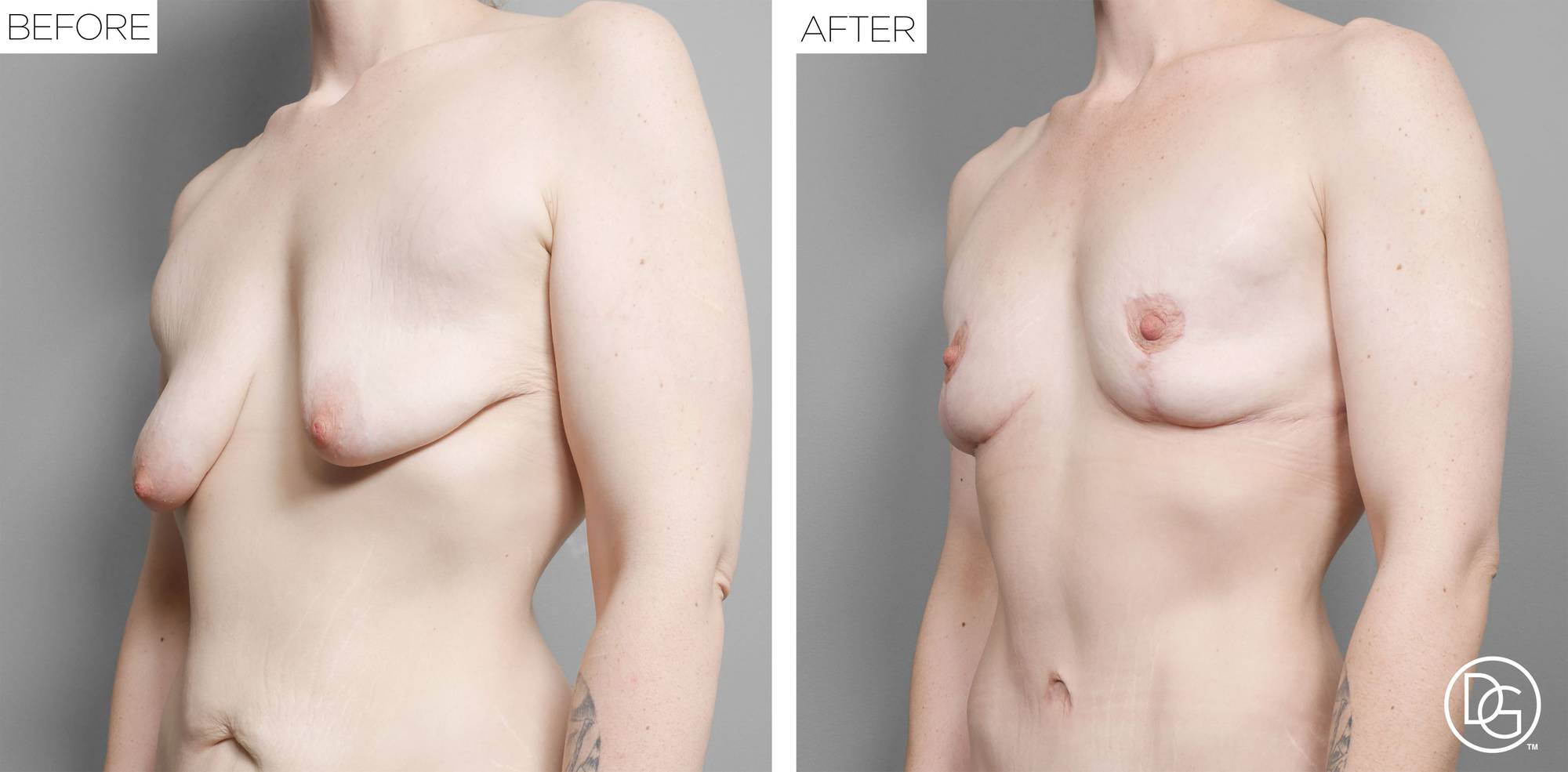 Breast Lift Before & After Image