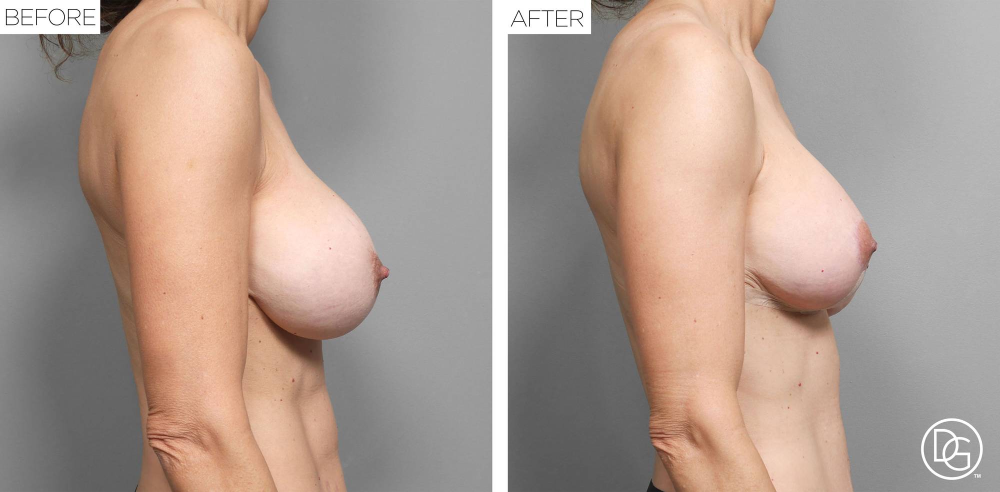 Breast Lift Before & After Image