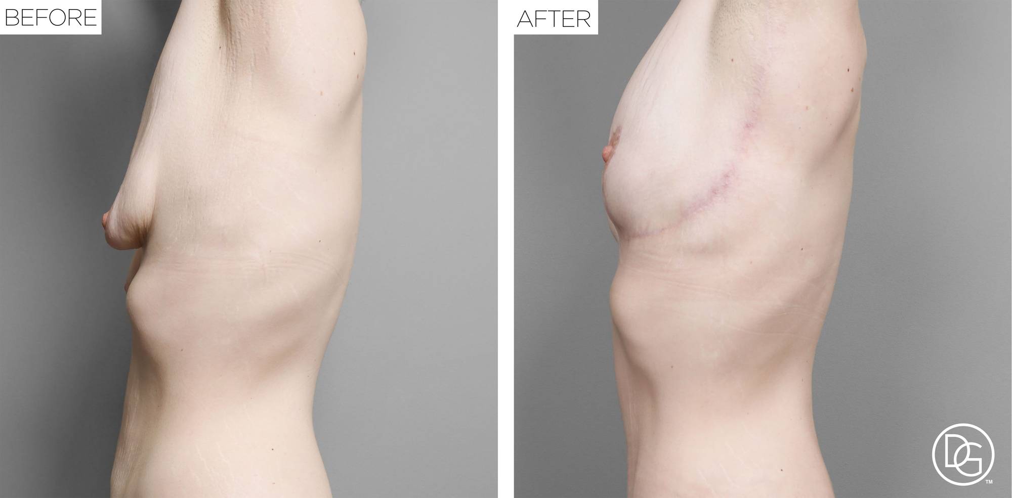 Breast Lift Before & After Image