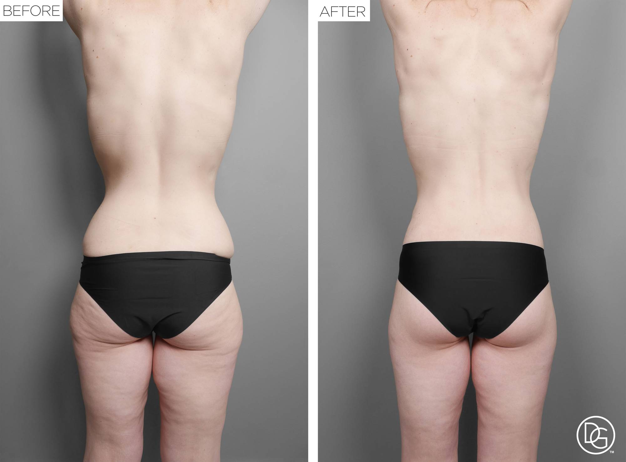 Back Lift Before & After Image