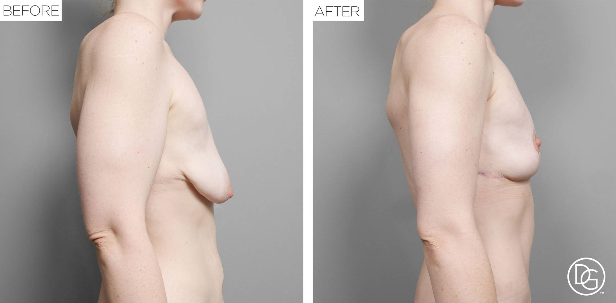 Breast Lift Before & After Image