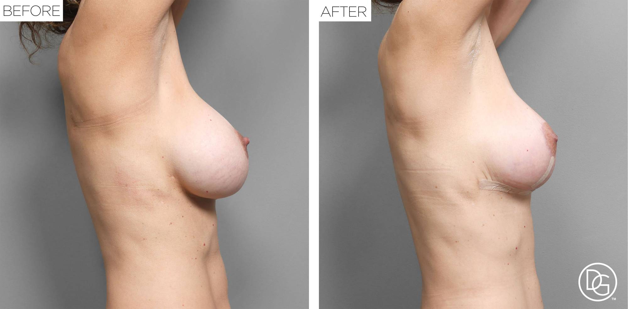 Breast Lift Before & After Image