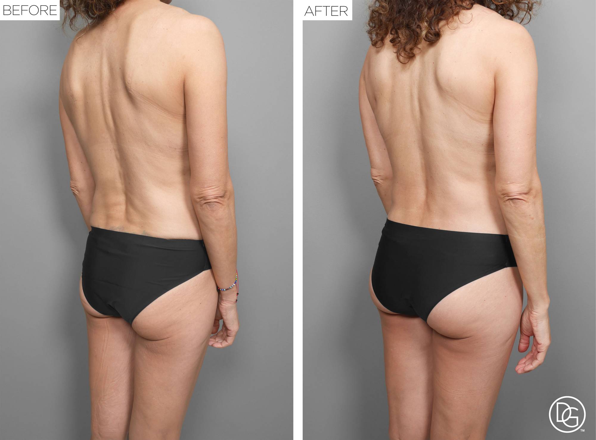 Back Lift Before & After Image
