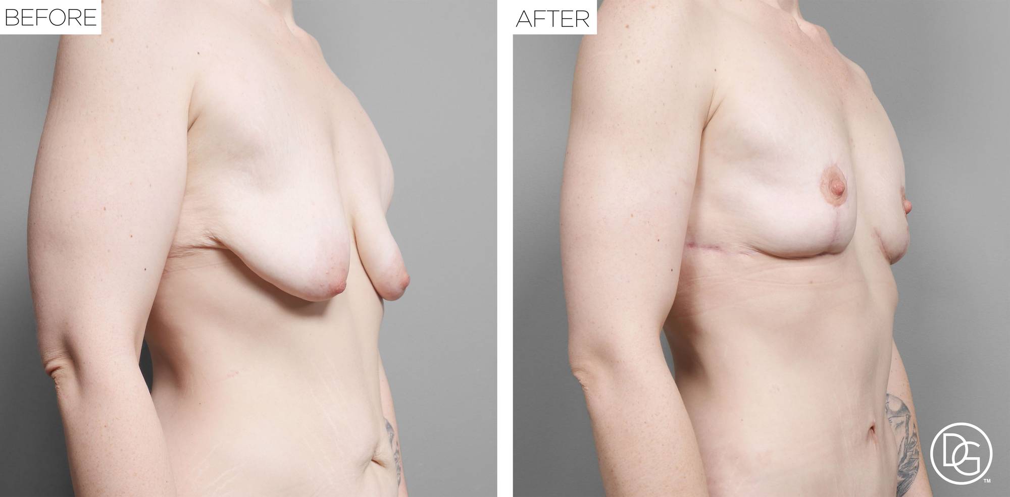 Breast Lift Before & After Image