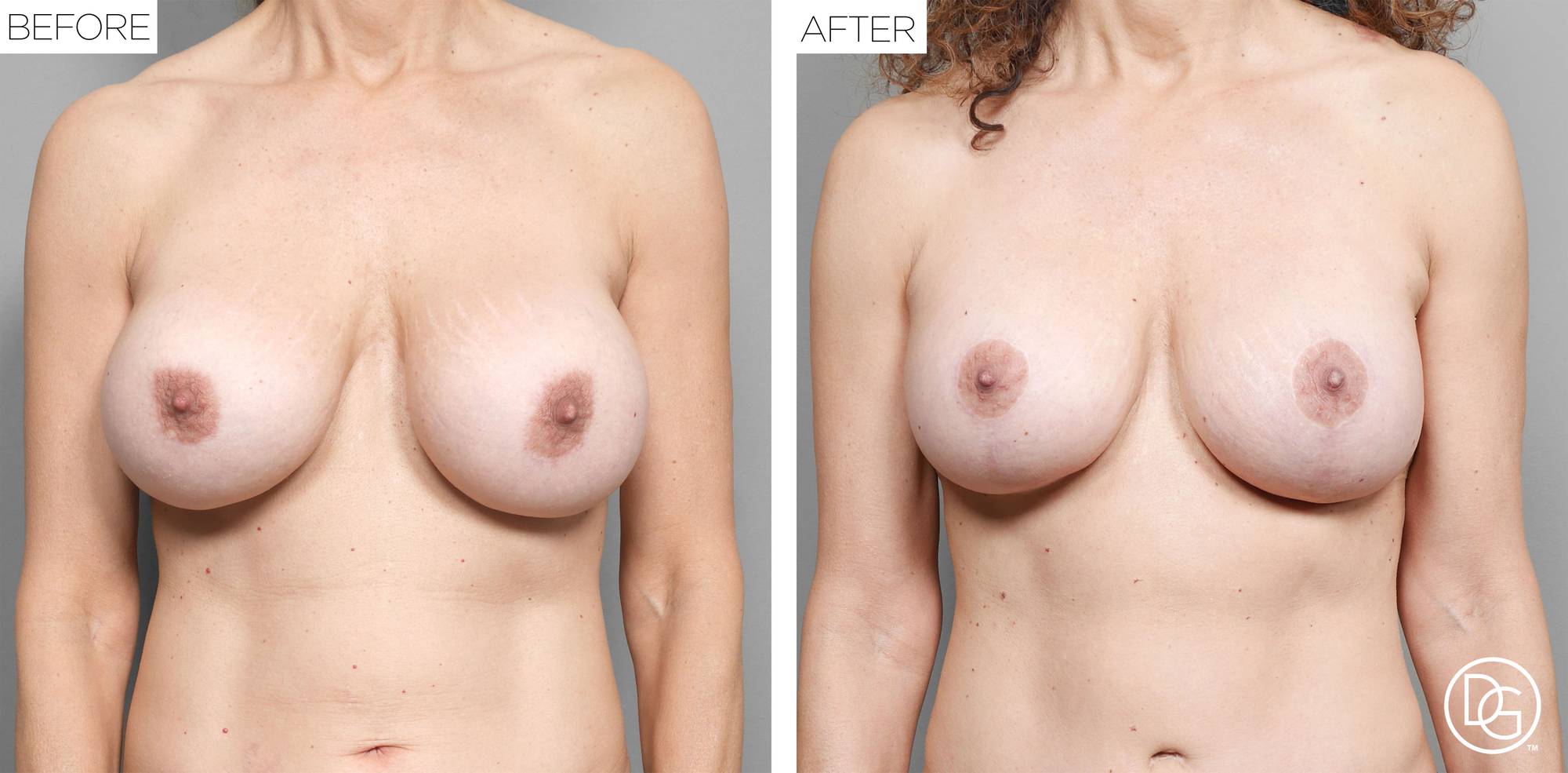 Breast Lift Before & After Image
