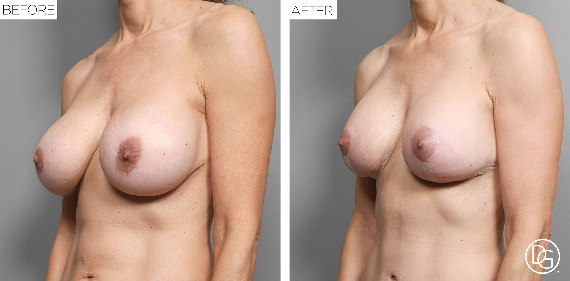 Breast Lift Before & After Image