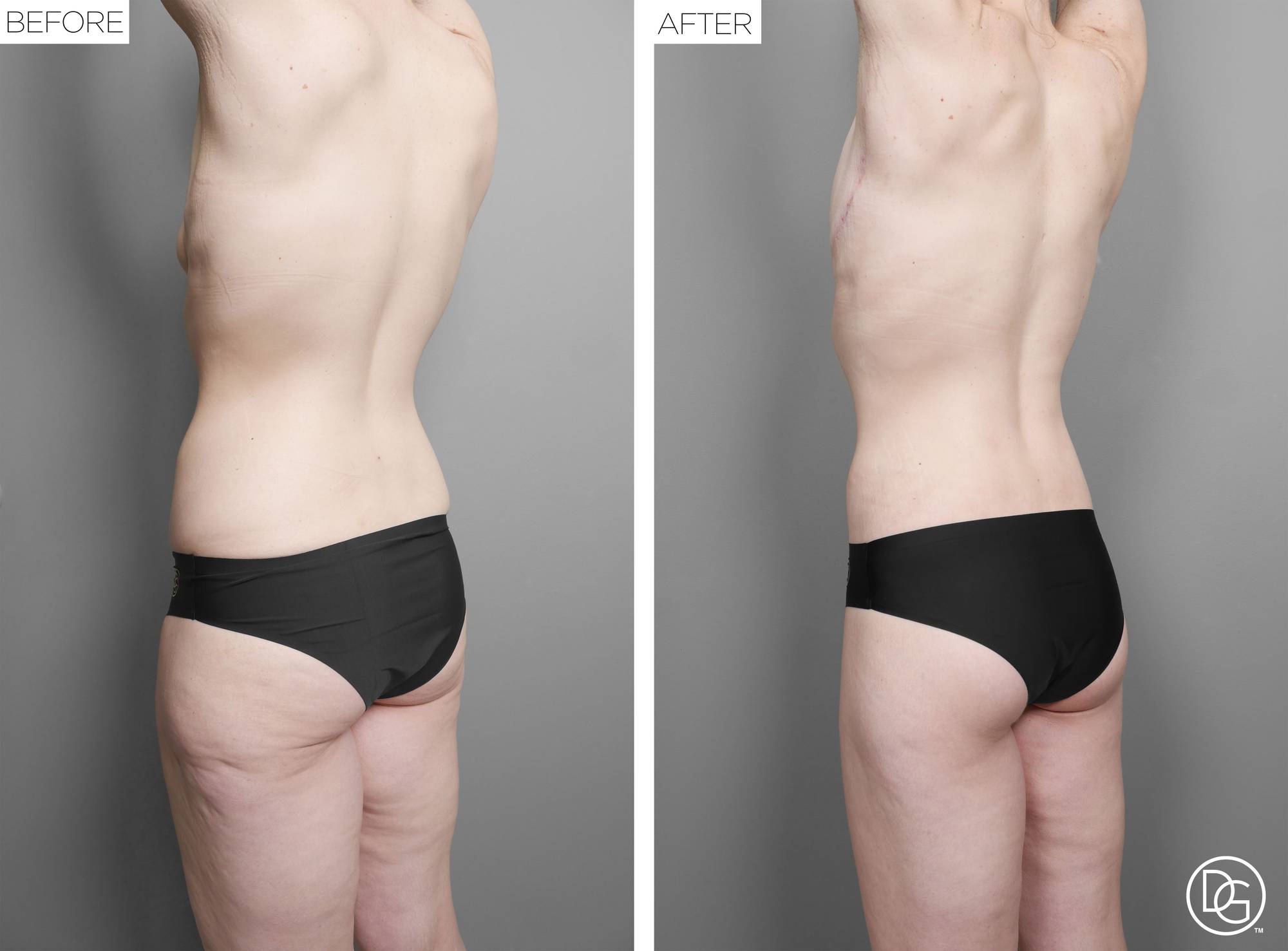 Back Lift Before & After Image