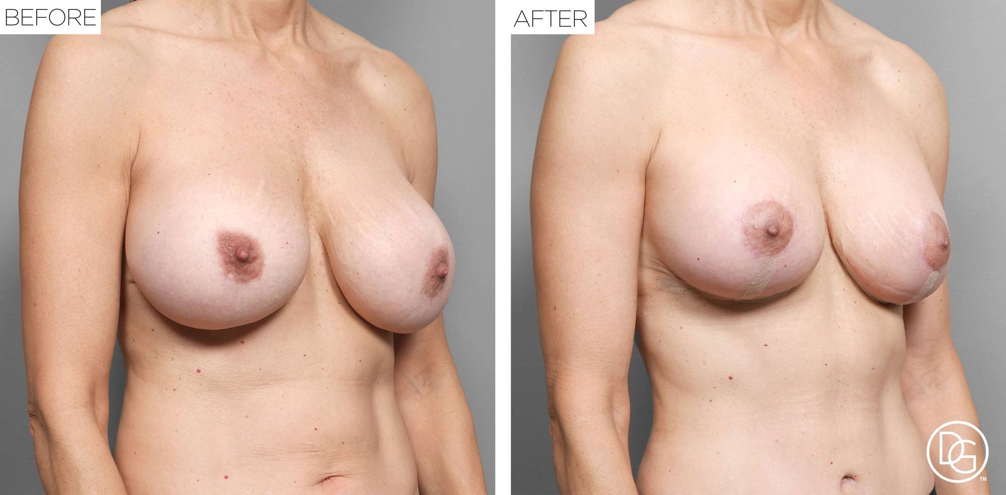 Breast Lift Before & After Image